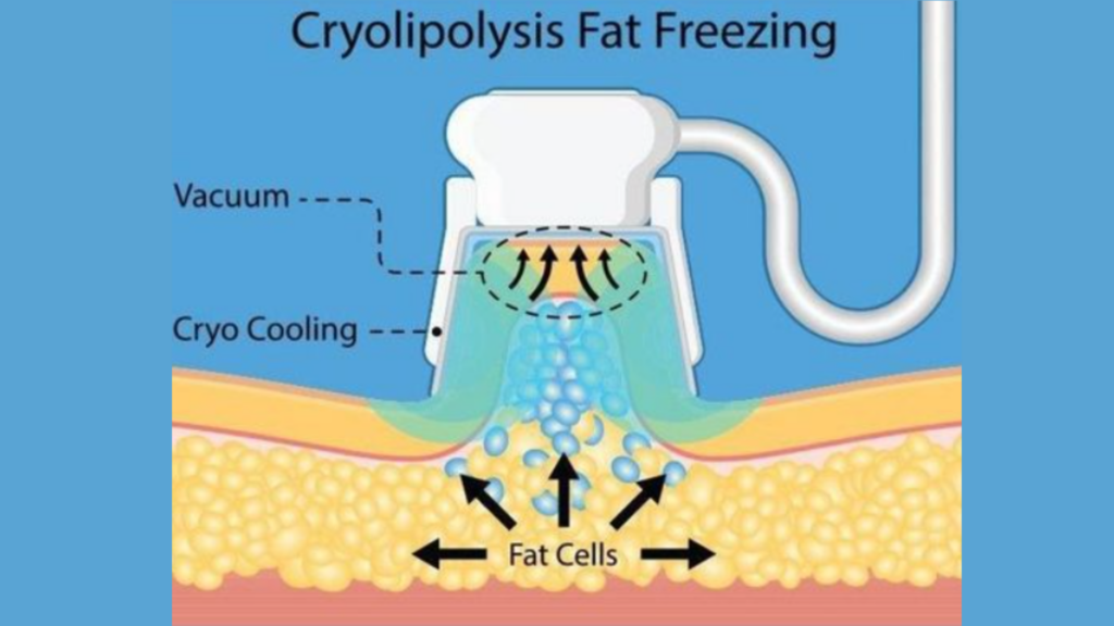 1 An educational illustration of Cryolipolysis Fat Freezing showing a device applying vacuum and cryo cooling to fat cells beneath the skin, demonstrating the non-invasive fat reduction process.